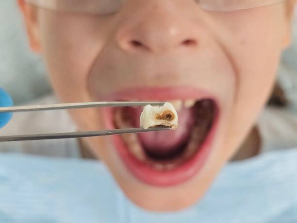 Best Emergency Dental Care for Broken or Chipped Teeth in Schenectady, NY